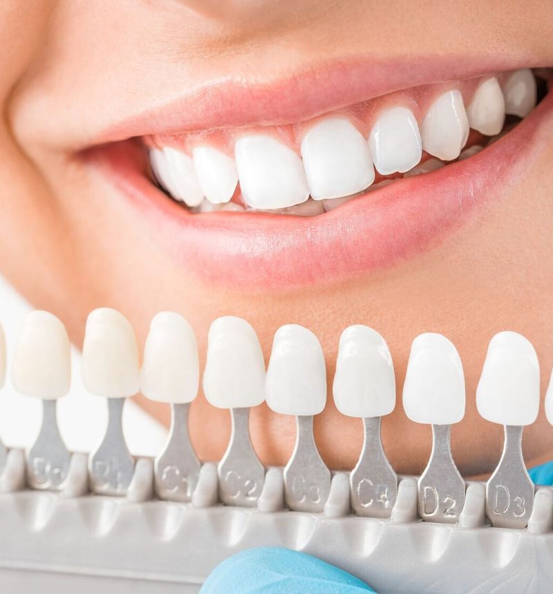 Cosmetic dentistry