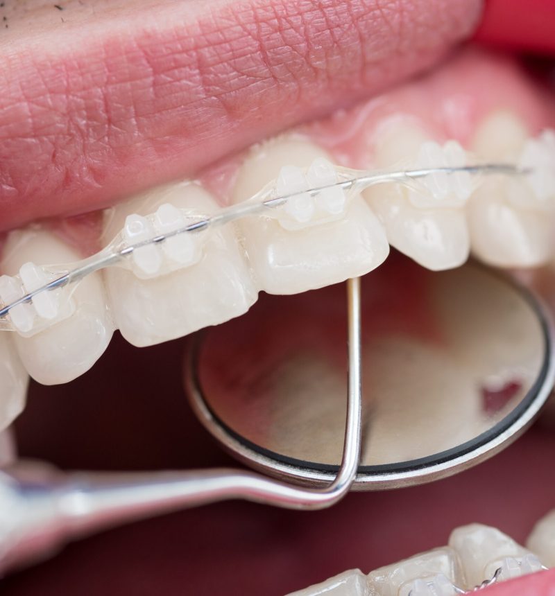 Dentist checking up teeth with ceramic brackets using dental tools - probe and mirror at the dental office. Macro shot of teeth with braces. Orthodontic Treatment. Dentistry