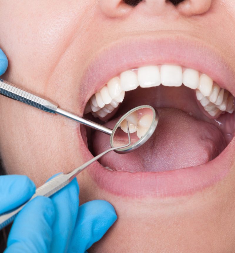 Closeup of dentist tools and mouth open with beautiful teeth