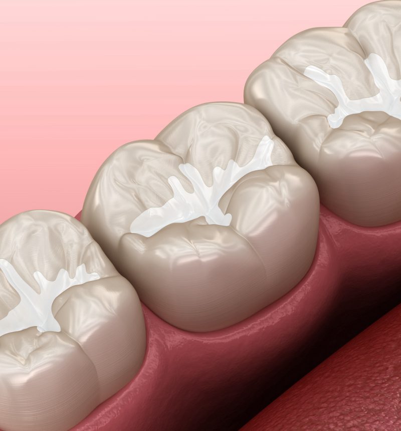 Molar Fissure dental fillings, Medically accurate 3D illustration of dental concept